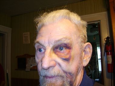 An old man with a black eye.